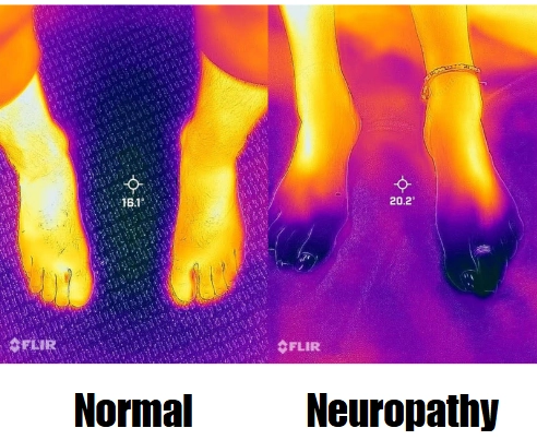 Chiropractic Littleton CO Neuropathy Normal